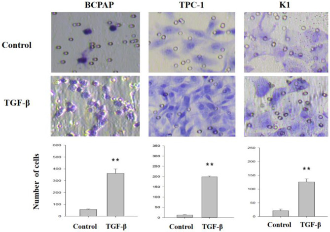 TGF-β induces EMT in thyroid cancer cells by regulating transcription factors.