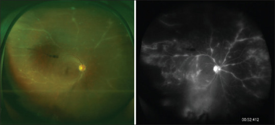 Epidemiological spectrum of infectious uveitis in the Asia-Pacific.