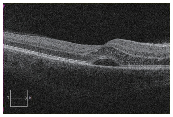 Clinical Characteristics and Visual Outcomes of Cat Scratch Disease.