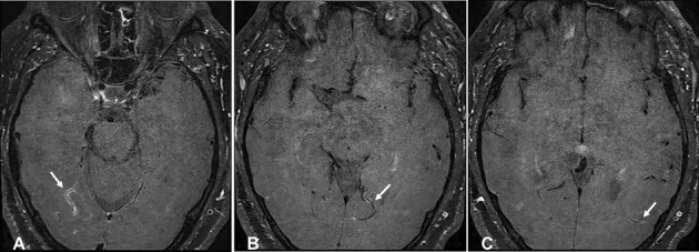 Clinical Images: High-resolution vessel wall magnetic resonance imaging detecting central nervous system vasculitis.