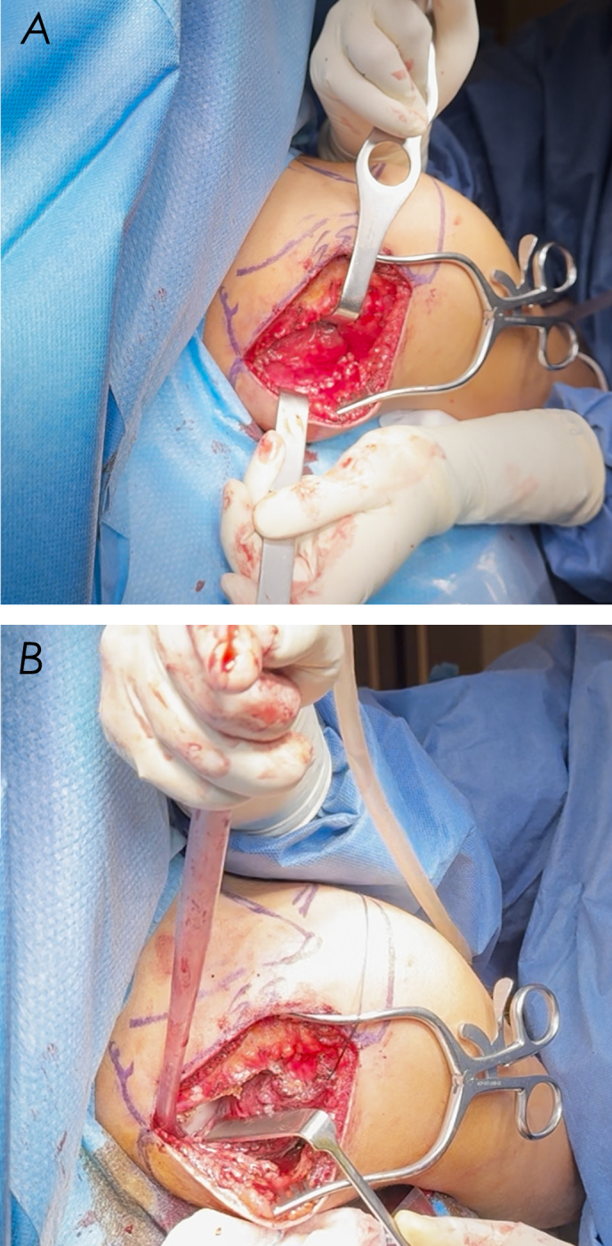 Shoulder paralysis as a presentation of septic arthritis with intramuscular scapular abscess - a case report.