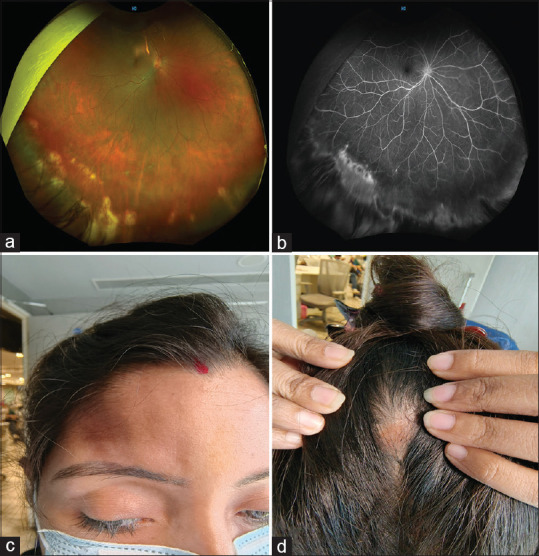 Uveitis in Parry-Romberg syndrome: A case report and review of literature.