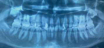 Optimizing Cosmetic Results in Dental Fluorosis: A Case Report of Bleaching and Microabrasion Techniques.