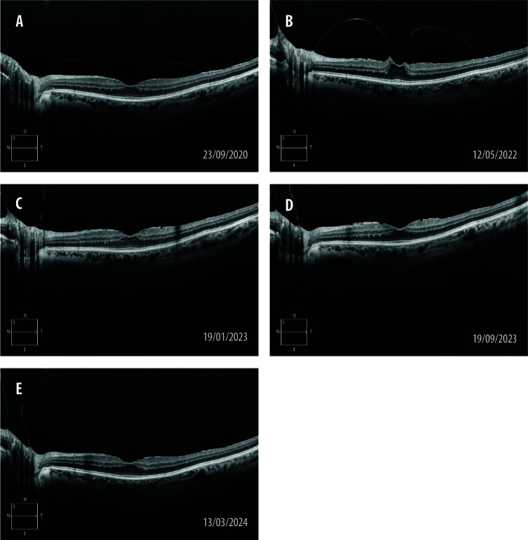 Prevention of epiretinal membrane traction progression with topical indomethacin treatment: a case report and mini literature review.