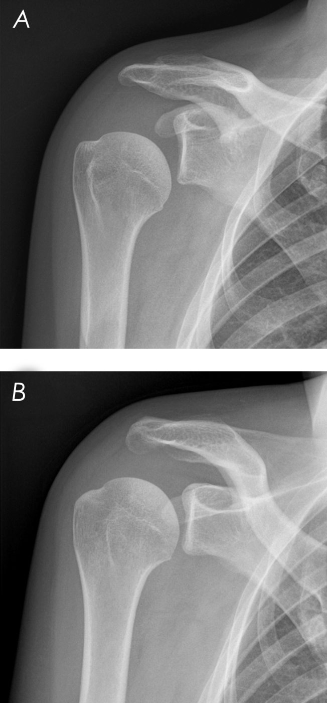 Shoulder paralysis as a presentation of septic arthritis with intramuscular scapular abscess - a case report.