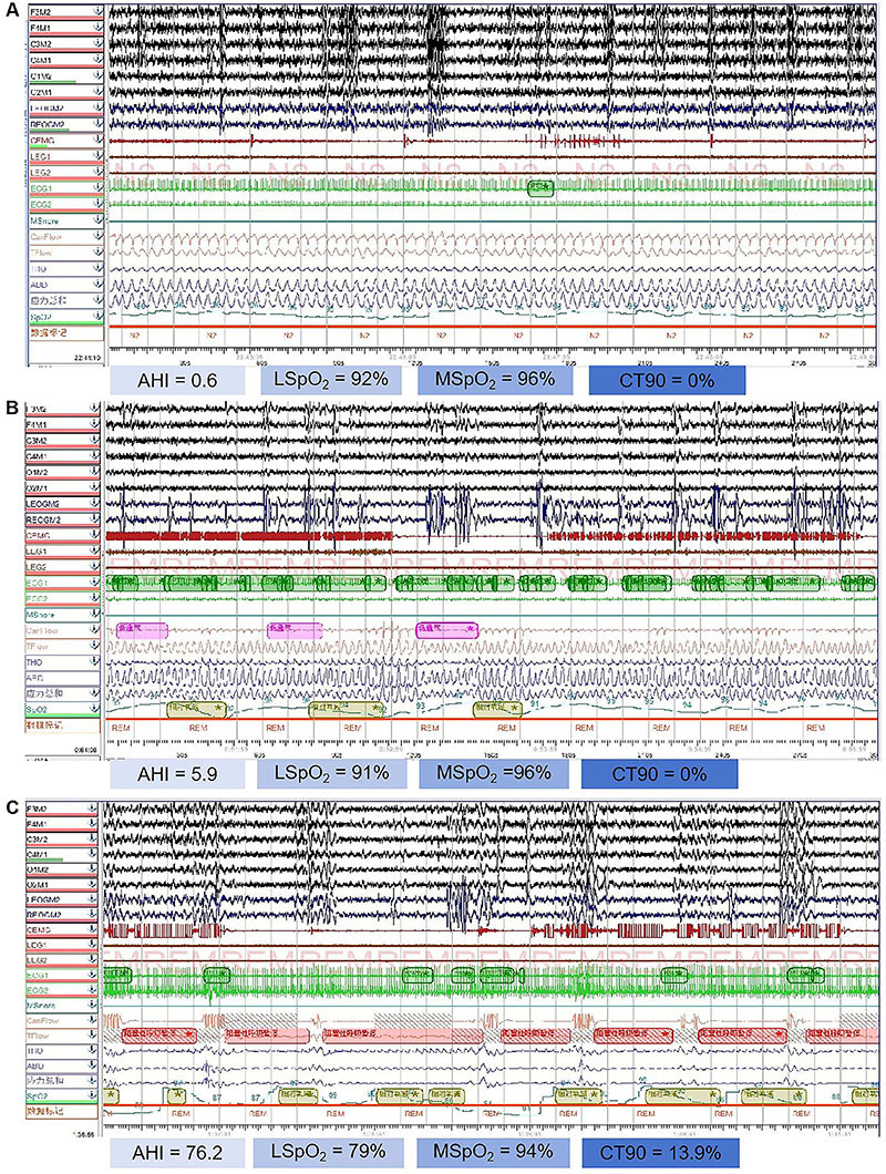 Prediction of early myocardial damage in obstructive sleep apnea patients using combined logistic regression and QUEST decision tree models.