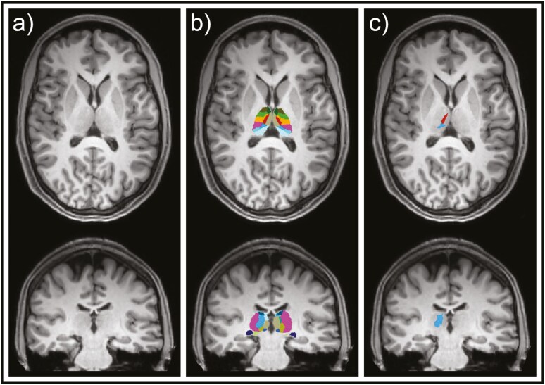 Acute effects of intranasal esketamine application on thalamic structures in healthy individuals.