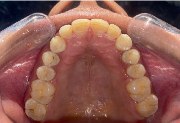 Optimizing Cosmetic Results in Dental Fluorosis: A Case Report of Bleaching and Microabrasion Techniques.