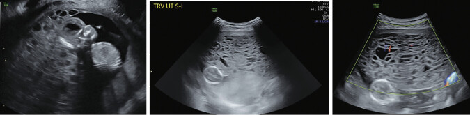 Thyroid Storm Triggered by Partial Hydatidiform Mole: A Rare and Life-Threatening Complication.