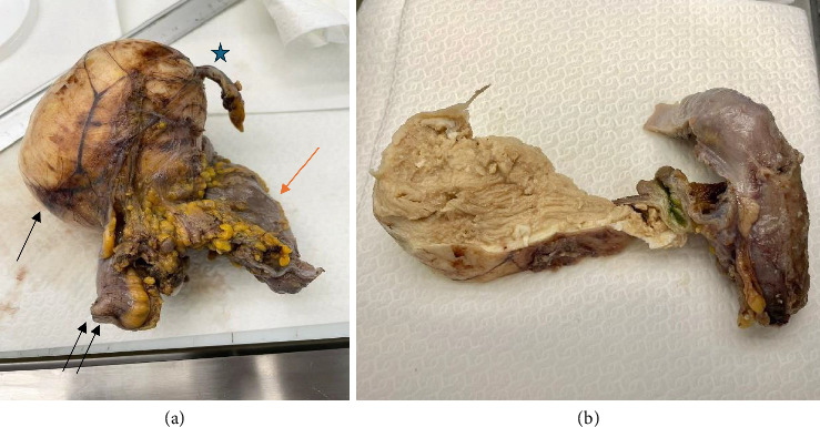 Epidermoid Cyst of the Cecum Treated by Laparoscopic Colectomy: A Case Report With Histopathology and Literature Review.
