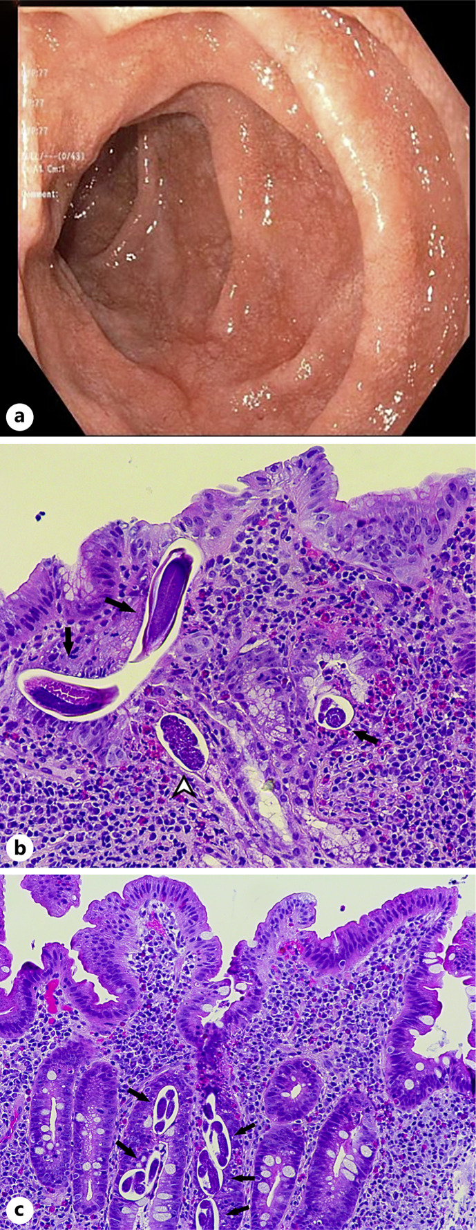 Gastroduodenal Strongyloidiasis Diagnosed during Iron Deficiency Anemia Workup.