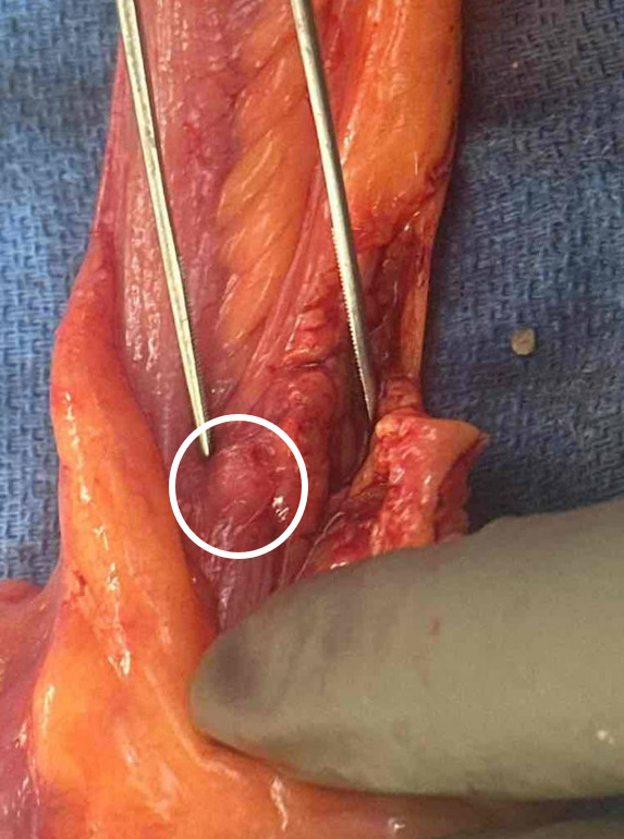 Massive lower gastrointestinal bleeding due to Meckel's diverticulum in an atypical position.