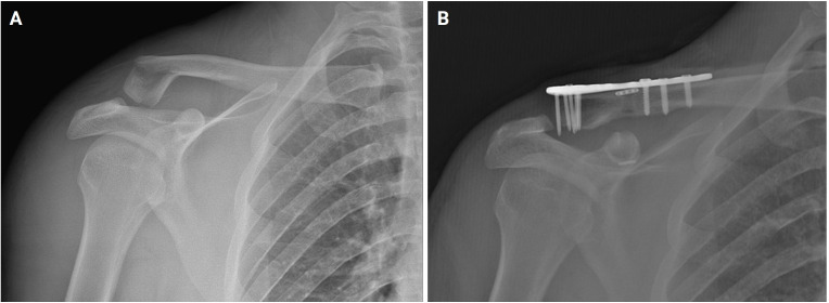 Importance of suture Endobutton augmentation in type 2B clavicle fracture fixation using a locking plate.