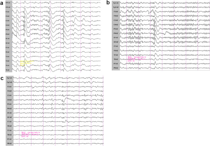 Type I Sialidosis in a Chinese family: a case report and literature review.