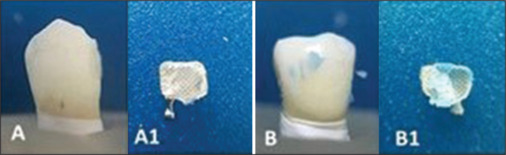 Debonding stresses of metal orthodontic brackets retained to tooth enamel with co-cured self-etch primer.