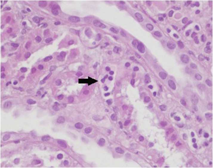 The role of peritubular capillaritis in severity of lupus nephritis.