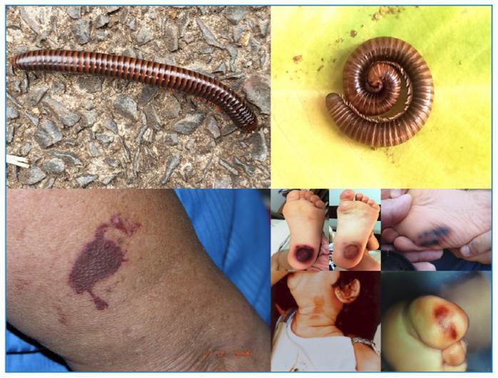 Myriapods (Diplopoda and Chilopoda): medical aspects of envenomations.