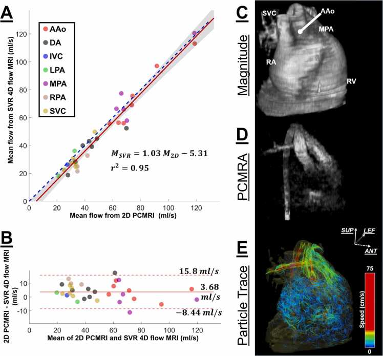 Rapid slice-to-volume four-dimensional flow in pediatric congenital heart disease: a feasibility study.