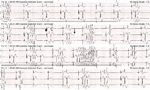 Sudden Cardiac Death due to Ventricular Fibrillation in a Dog Following Packed Red Blood Cell Transfusion.