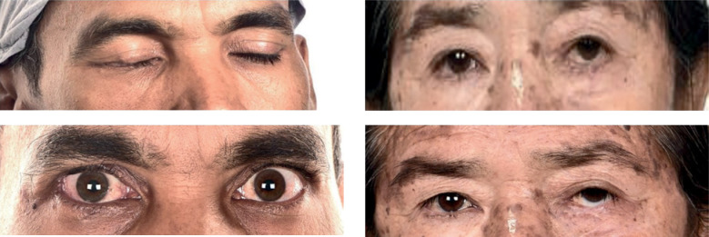Brachytherapy for eyelid cancers: Re-defining outcomes and esthetics in rare histologies.