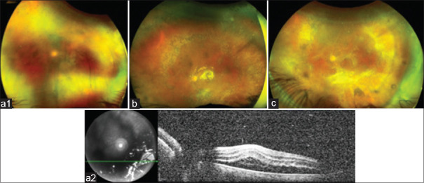 Clinical features and outcomes of Rhegmatogenous Retinal Detachments in Acute Retinal Necrosis.