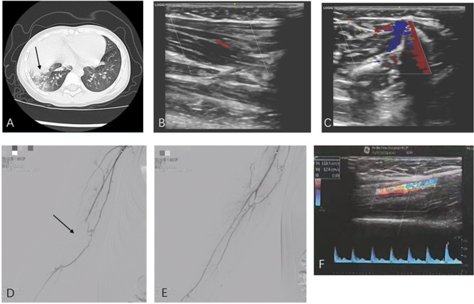 Interventional therapy for a case of Mycoplasma pneumoniae pneumonia complicated by upper extremity arterial embolism in a child: a case report.
