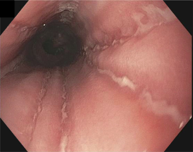 Upadacitinib for the Treatment of Upper Gastrointestinal Crohn's Disease.