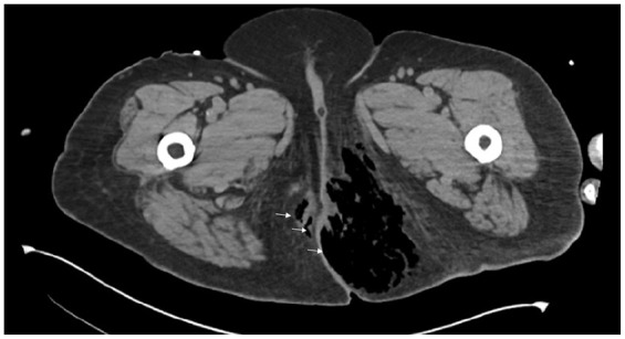 Pleiotropic Effects of Cocaine Abuse in Hyperglycemic Crisis: Main Culprit or Accomplice but Never an Innocent Bystander.