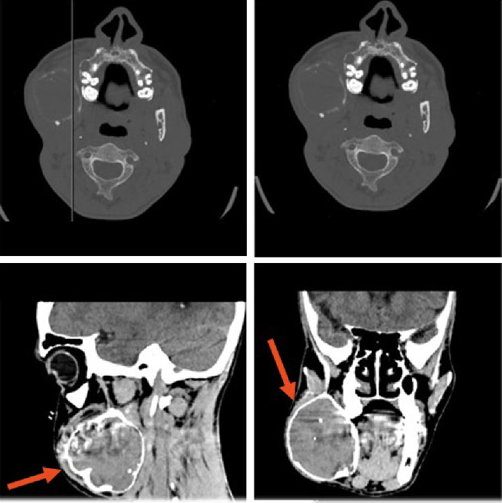 Hyperparathyroidism-Jaw Tumor Syndrome Associated to a CDC73 Gene Pathogenic VARIANT and a Nonossifying Desmoplastic Fibroma of the Mandible.