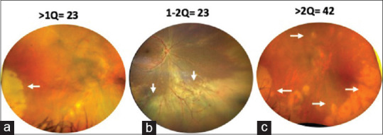 Clinical features and outcomes of Rhegmatogenous Retinal Detachments in Acute Retinal Necrosis.