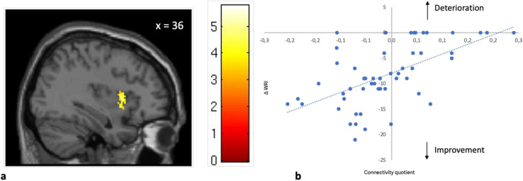 Functional connectivity of the nucleus accumbens predicts clinical course in medication adherent and non-adherent adult ADHD.