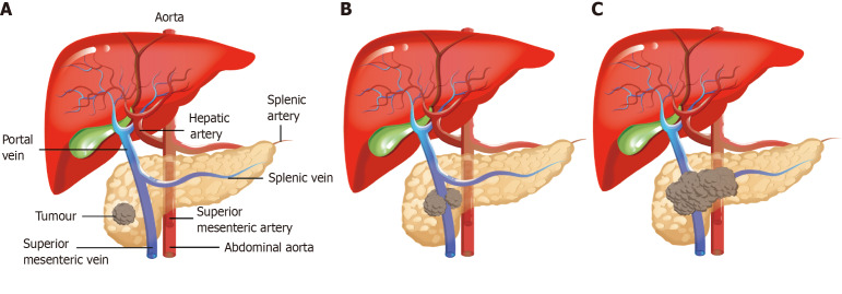 Advances in neoadjuvant therapy for pancreatic cancer: Current trends and future directions.