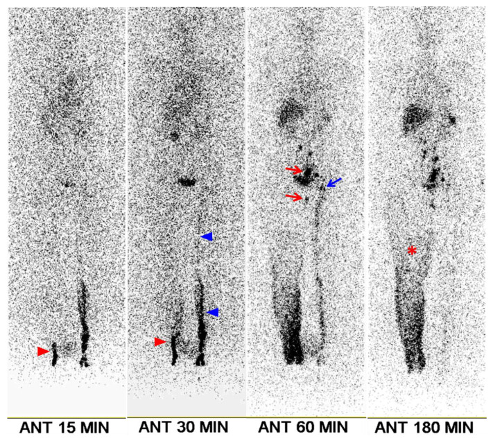 Predicting the Outcome of Lymphovenous Anastomosis for Lower Extremity Lymphedema through Lymphoscintigraphy.