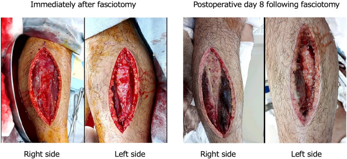 Systemic capillary leak syndrome complicated by lower extremity compartment syndrome: a case report.