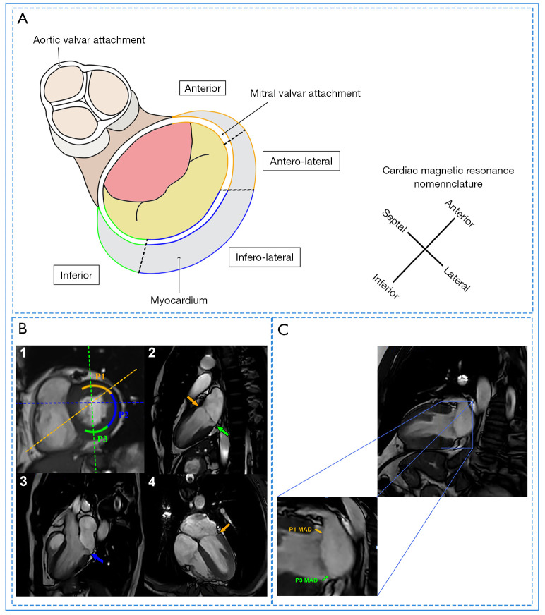 Characteristics and clinical implication of mitral annular disjunction in apparently normal hearts: a cardiac magnetic resonance study.