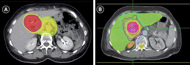 Definitive radiotherapy for unresectable extrahepatic cholangiocarcinoma: is it time for an update?