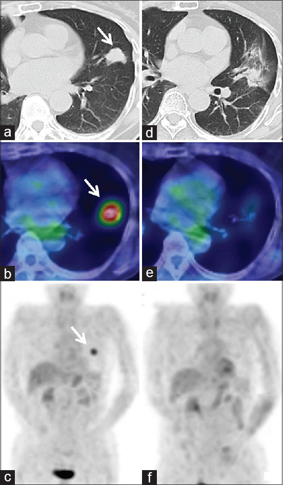 A Decade-long Battle: Successful Stereotactic Radiotherapy for a Delayed Lung Metastasis from Endometrial Cancer.