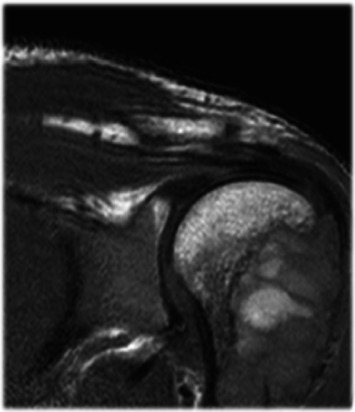 Hyperparathyroidism-Jaw Tumor Syndrome Associated to a CDC73 Gene Pathogenic VARIANT and a Nonossifying Desmoplastic Fibroma of the Mandible.