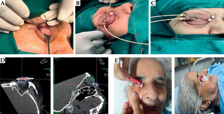 Brachytherapy for eyelid cancers: Re-defining outcomes and esthetics in rare histologies.