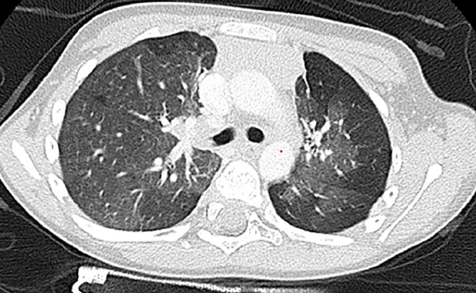 The Role of Pulmonary Genetic Variations in the Pathogenesis of Pediatric Postinfectious Bronchiolitis Obliterans.