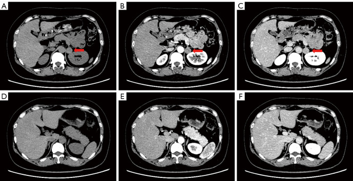 Primary aldosteronism patients with bilateral adrenal vein sampling success achieve better outcomes through unilateral adrenalectomy.
