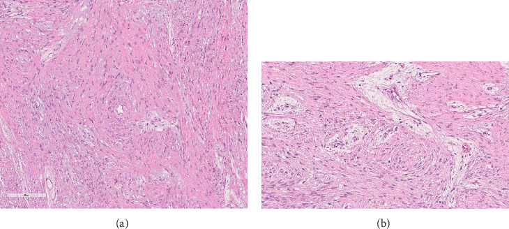 Hyperparathyroidism-Jaw Tumor Syndrome Associated to a CDC73 Gene Pathogenic VARIANT and a Nonossifying Desmoplastic Fibroma of the Mandible.