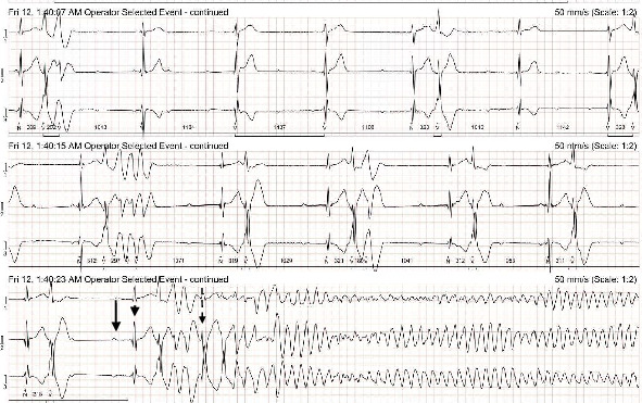 Sudden Cardiac Death due to Ventricular Fibrillation in a Dog Following Packed Red Blood Cell Transfusion.