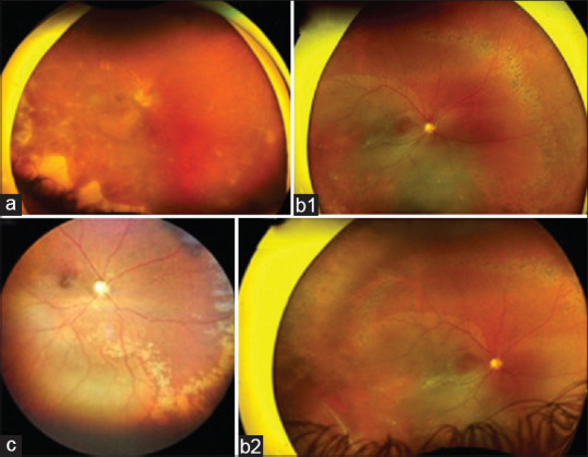Clinical features and outcomes of Rhegmatogenous Retinal Detachments in Acute Retinal Necrosis.