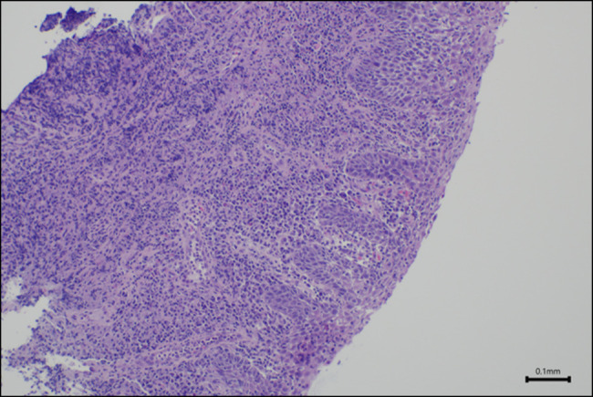 Upadacitinib for the Treatment of Upper Gastrointestinal Crohn's Disease.
