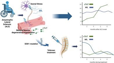 Serum Cardiac Troponin T Levels as a Therapy Response Marker in Tofersen-Treated ALS.