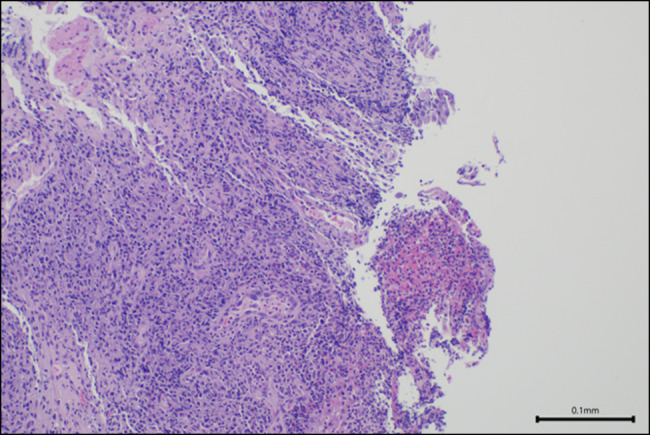 Upadacitinib for the Treatment of Upper Gastrointestinal Crohn's Disease.