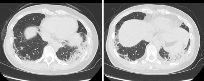 Anti-OJ Antibody-positive Antisynthetase Myopathy Diagnosed after Pulmonary Embolization.