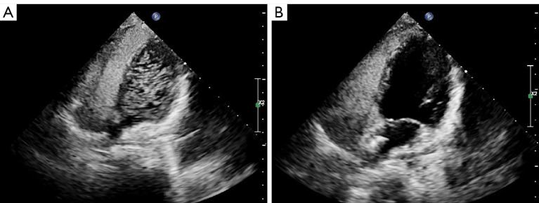Preliminary study on the application of percutaneous patent foramen ovale (PFO) closure in the treatment of children with PFO and severe migraine.