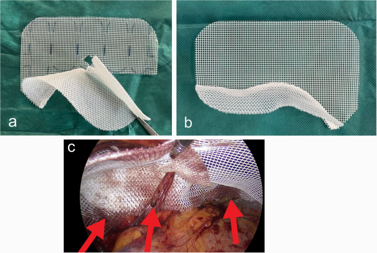 Do we have to rethink slit-mesh technique in endoscopic inguinal hernia repair? - A matched pair analysis.